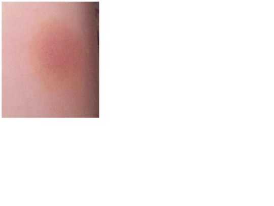 info/makeup-bruise screenshot